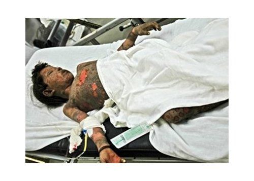 child_burnt-afghanistan1.jpg